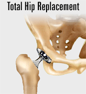 Total Hip Replacement